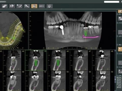 Ejemplo de tomografía 3d (cbct) tomada en El Radiológico Oral